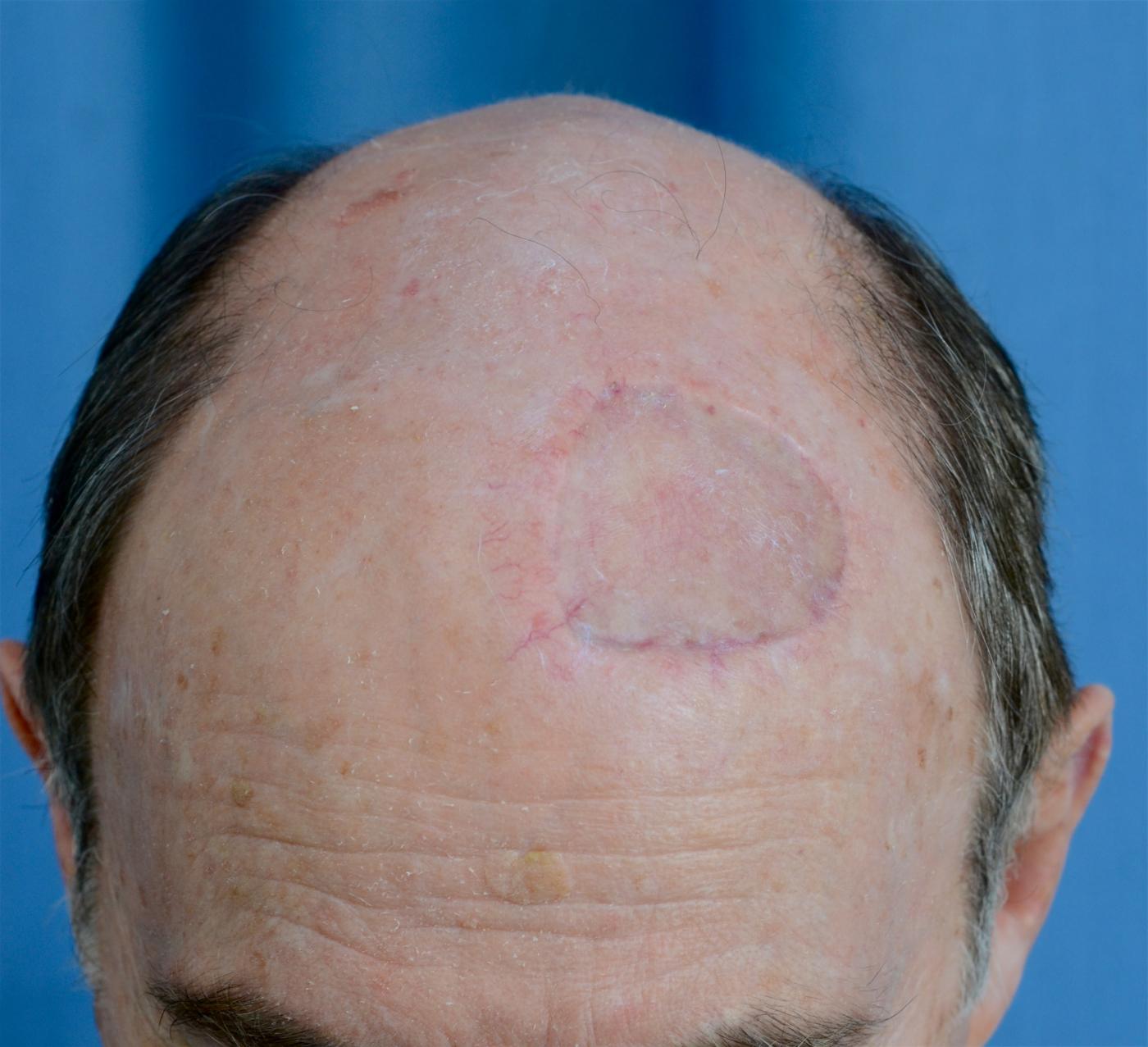 Post Op Wound Healing & Care Dr Stretch