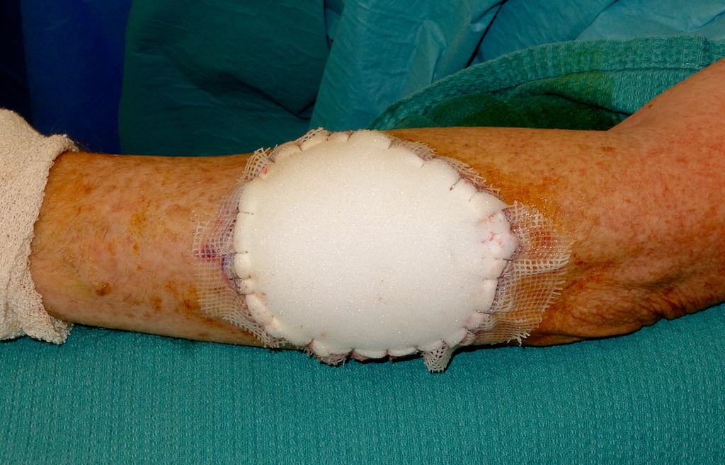 Post Op Wound Healing & Care Dr Stretch